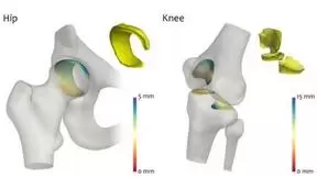 人工智能的应用：关节炎领域的新发现