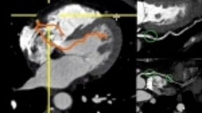 阿里巴巴攻克AI心血管识别 0.5秒提取单根血管