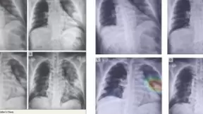 向全球开放--点内AI 新冠肺炎X-ray分析平台