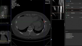 联影智能联席CEO沈定刚教授：获NMPA首张CT骨折AI三类证后，“下沉”与“拓展”将成未来关键