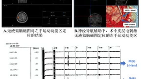 全球首例无液氦脑磁图辅助下的胶质瘤切除手术顺利完成