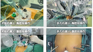 郑大一附院成功完成 12 例蛇形臂单孔机器人辅助食管癌根治术 —— 开创食管癌微创新纪元